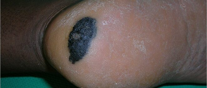 Acral lentiginous melanoma on heel