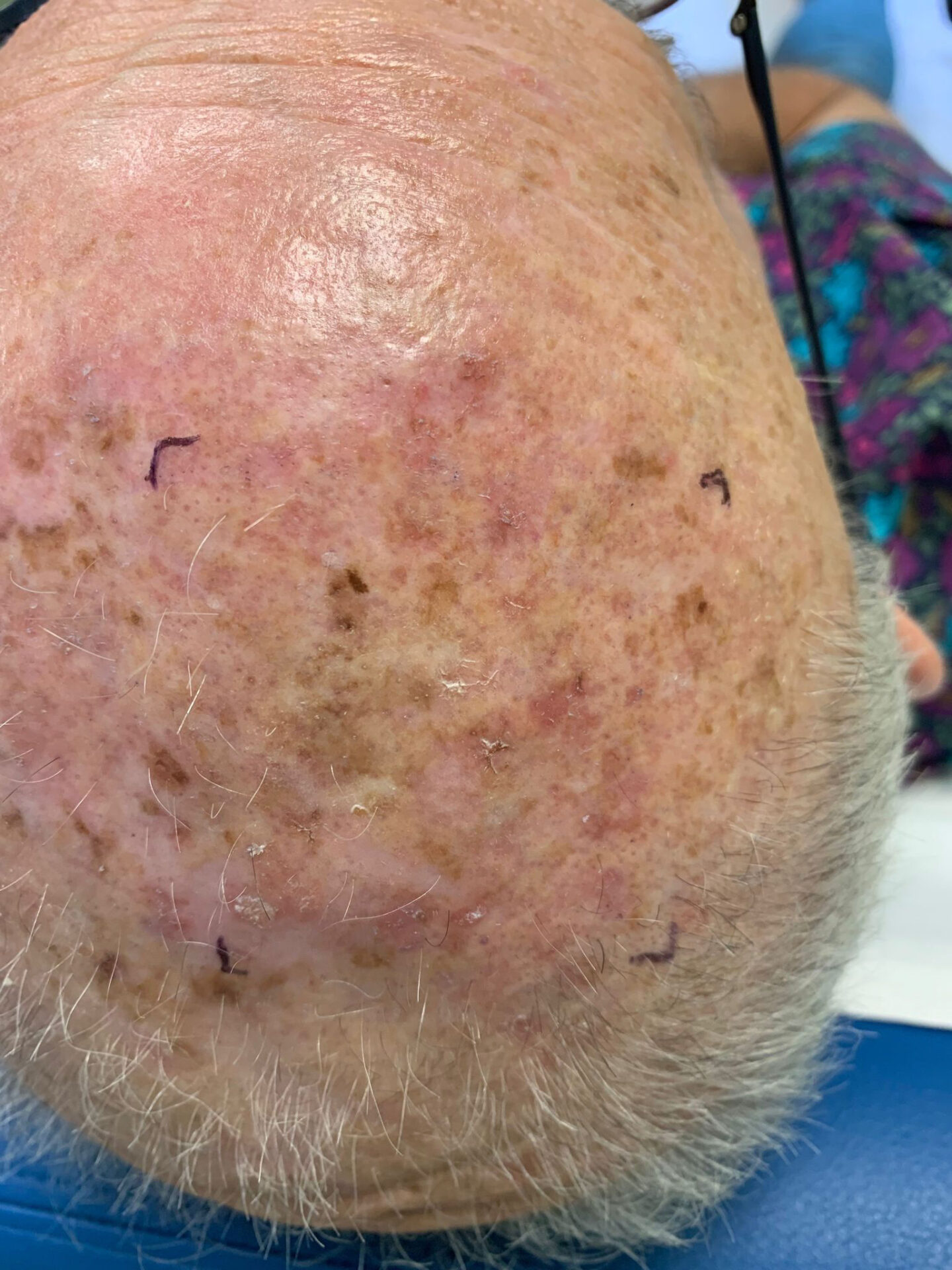 Actinic keratoses on scalp