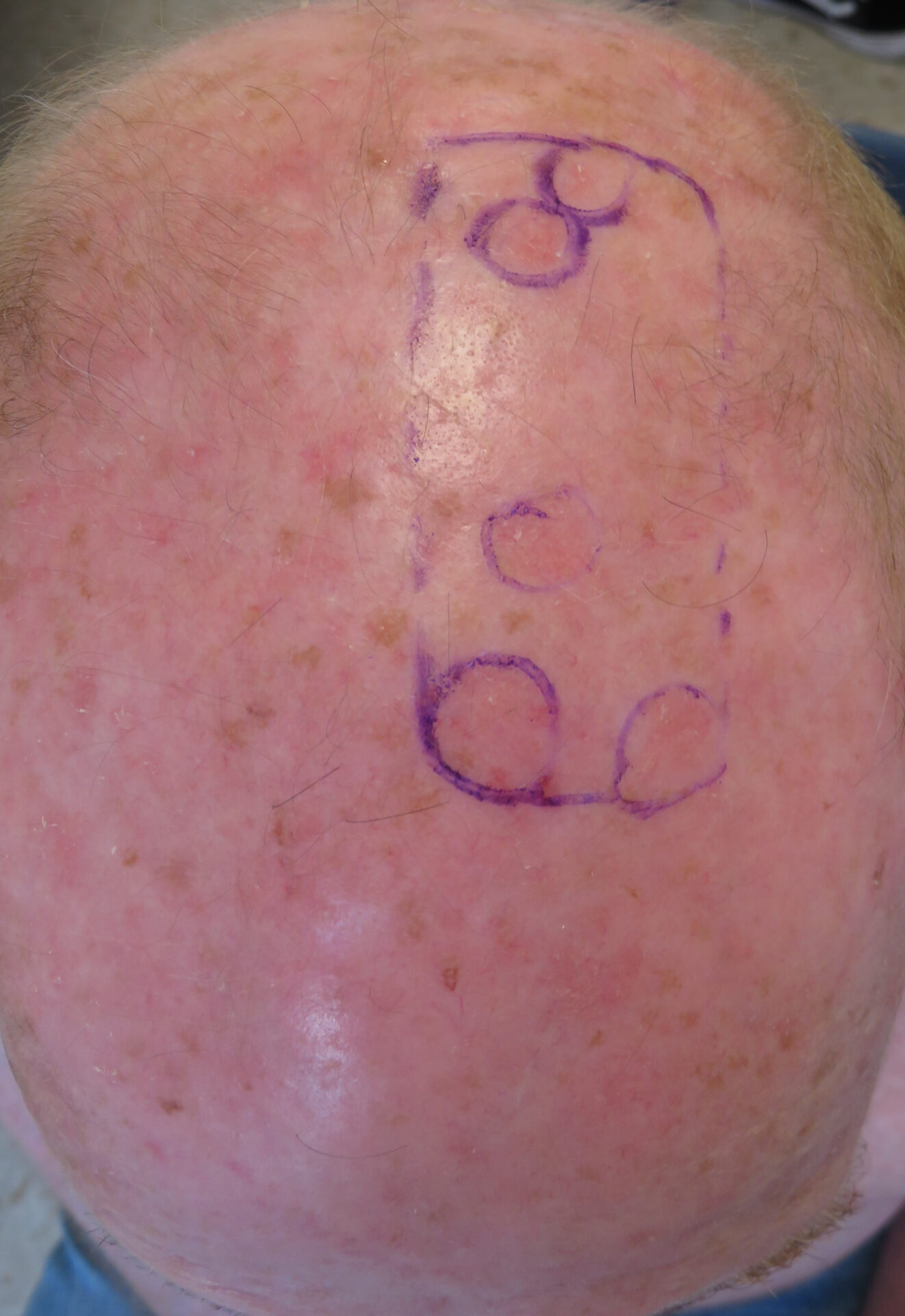 AKs on scalp. Photo_ Almirall, SA