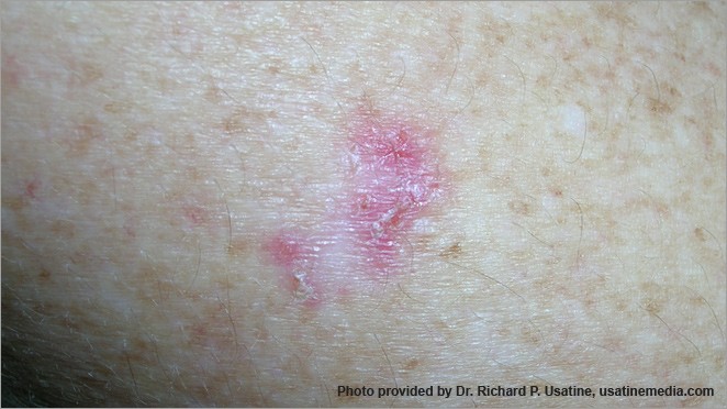 Basal cell carcinoma