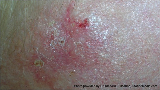 Basal cell carcinoma – a red, irritated patch