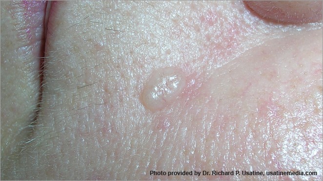 Basal cell carcinoma on cheek