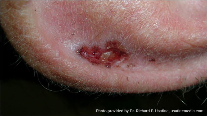 Basal cell carcinoma on ear