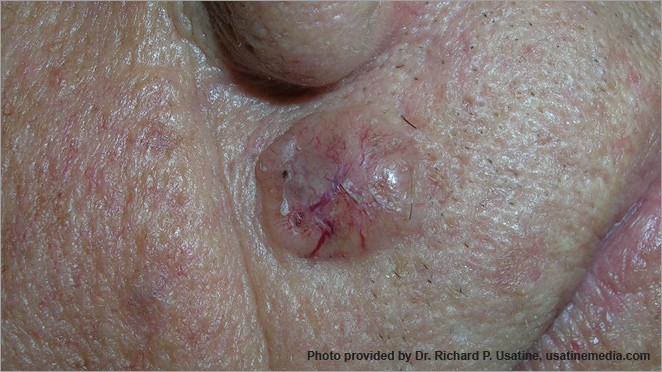 Basal cell carcinoma, shiny bump above upper lip