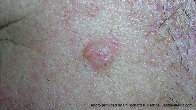 Basal cell carcinoma – shiny bump