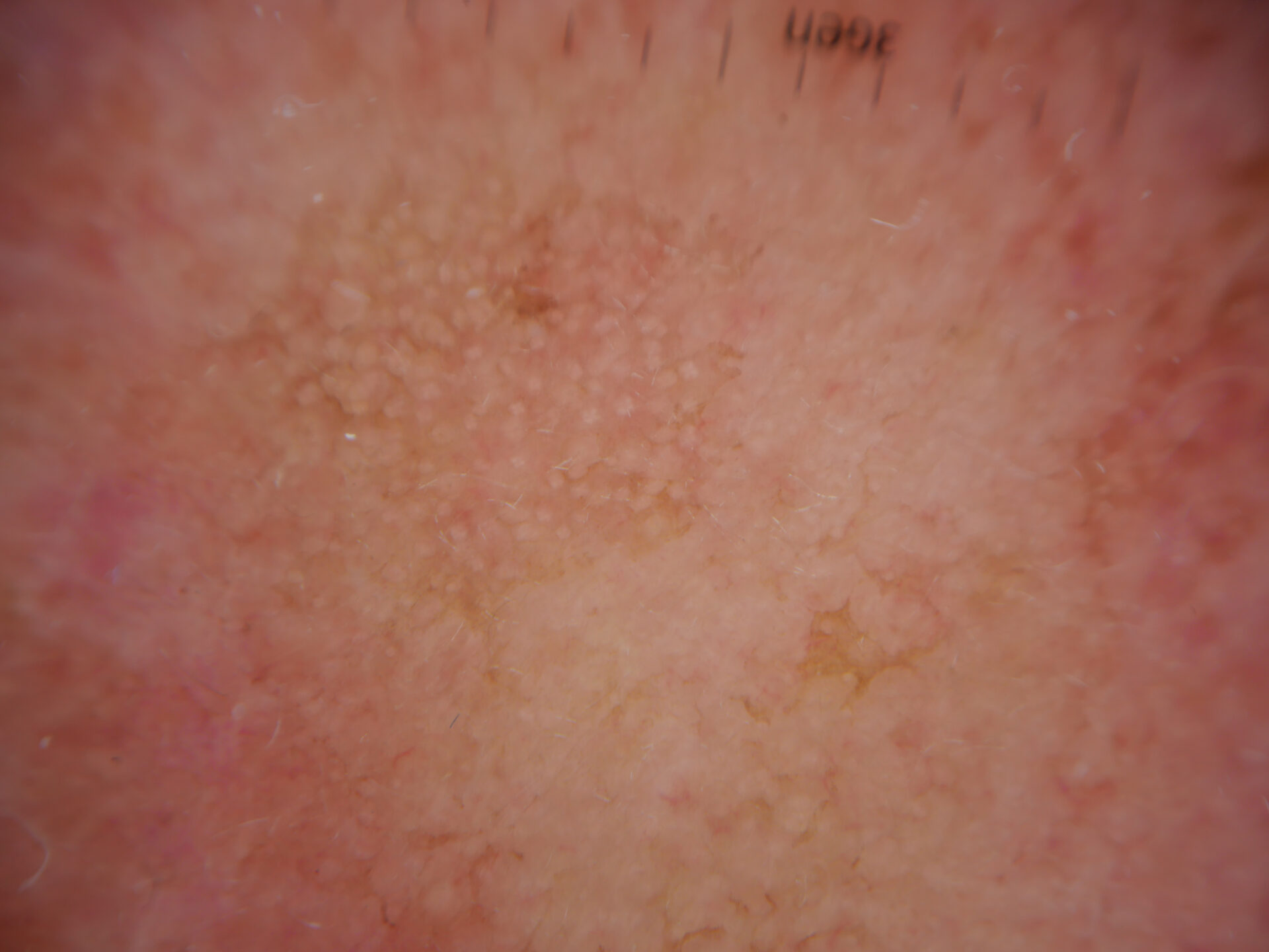 Close up of actinic keratoses on scalp. Photo_ Almirall, SA