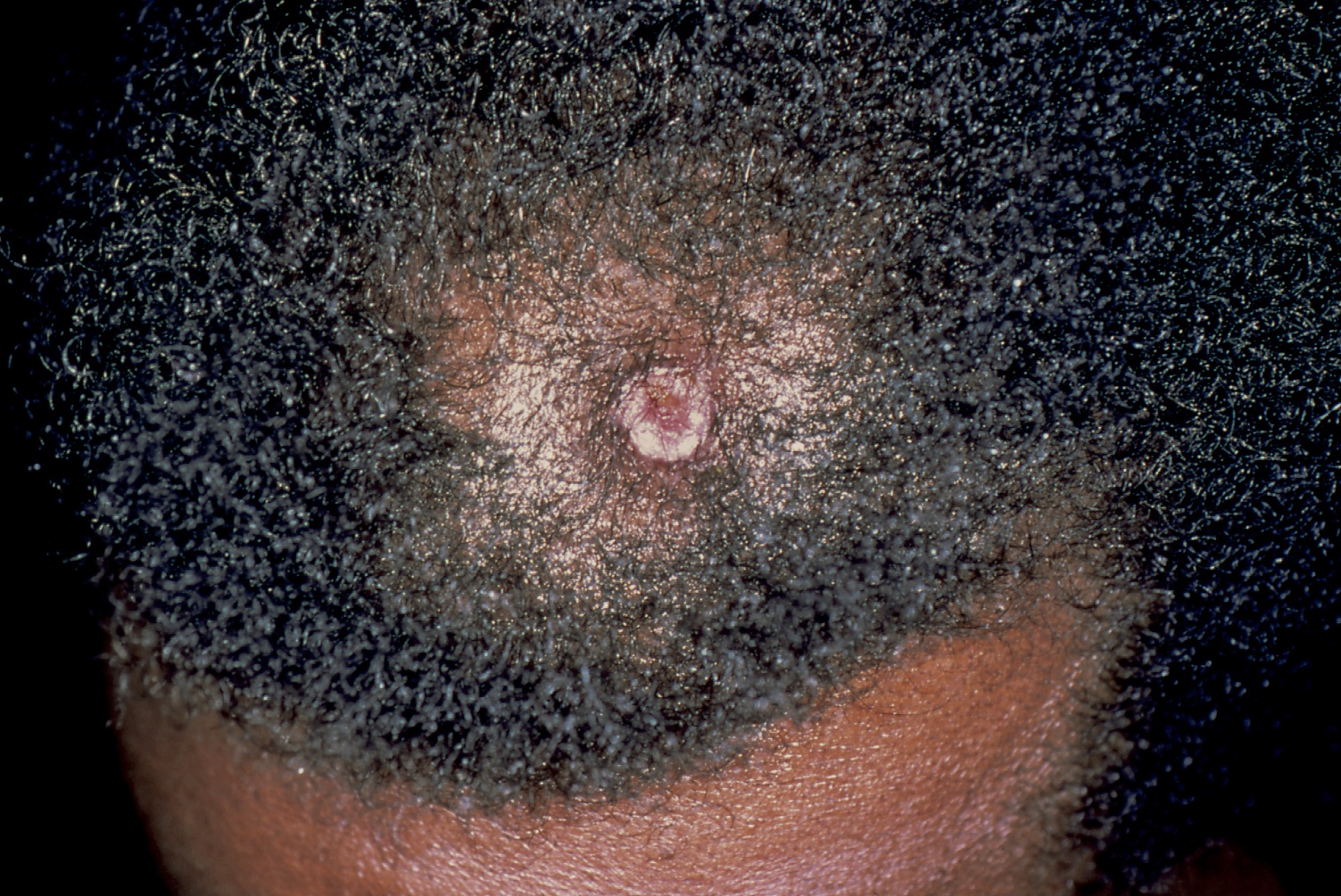 CSCC on the scalp of a Black man