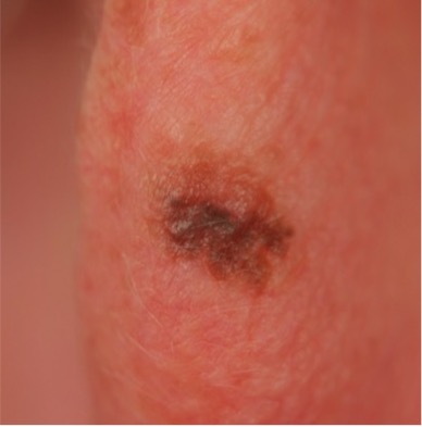 melanoma in situ