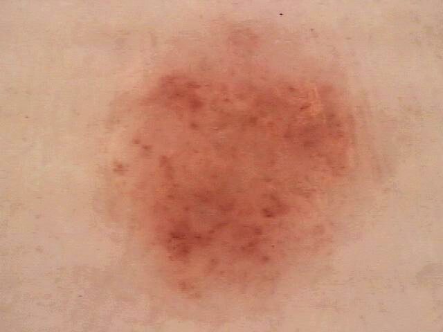 ISIC_5008132 Actinic keratosis