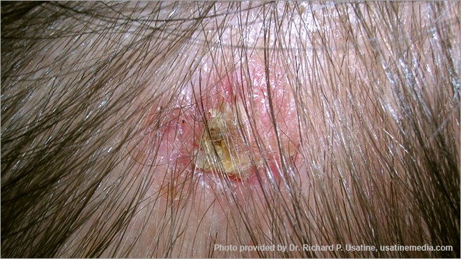 Large basal cell carcinoma on scalp