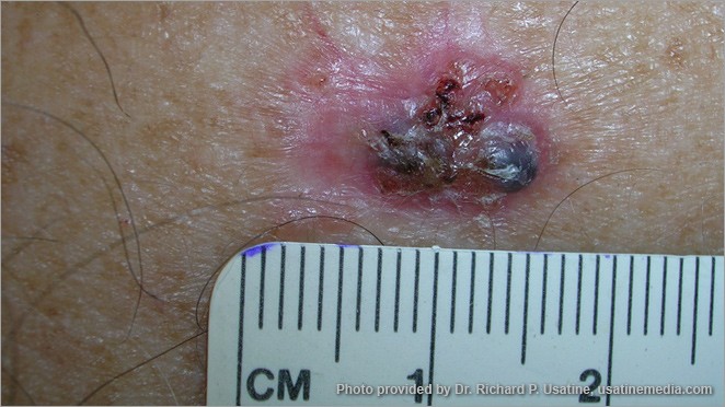 Large basal cell carcinoma