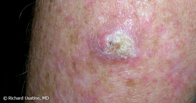 Large, crusty squamous cell carcinoma