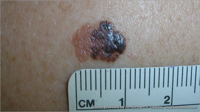 Large melanoma with varied colors