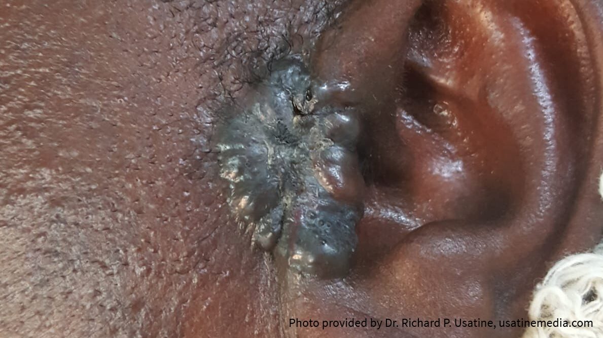 Large, pigmented basal cell carcinoma