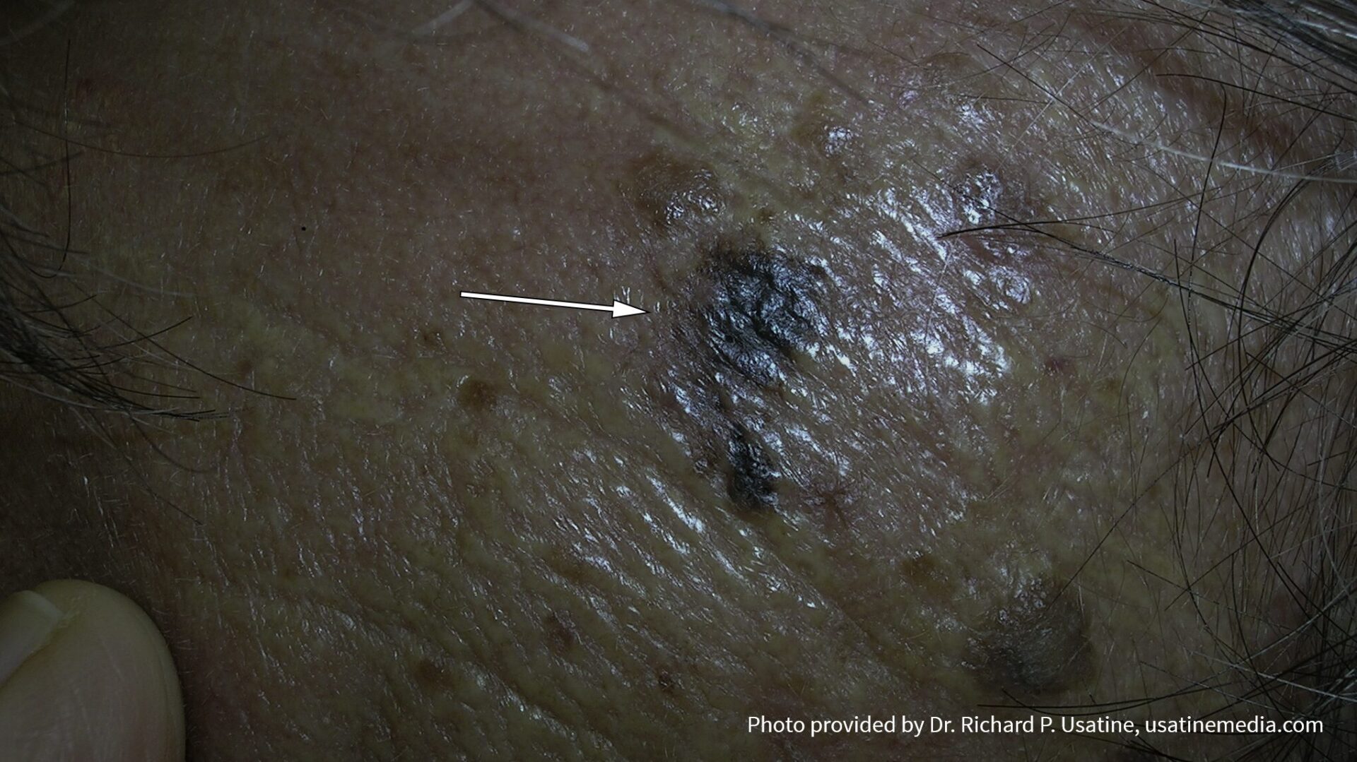 Melanoma, irregular borders