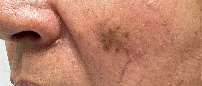 Melanoma on cheek