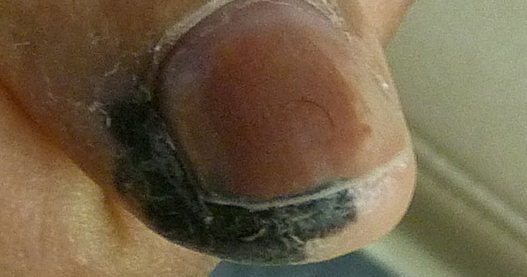 Melanoma on finger