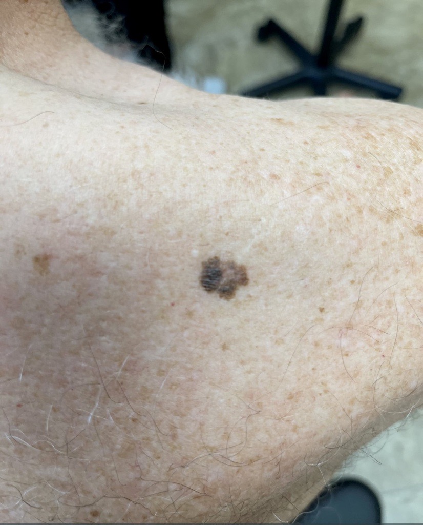 Melanoma Image