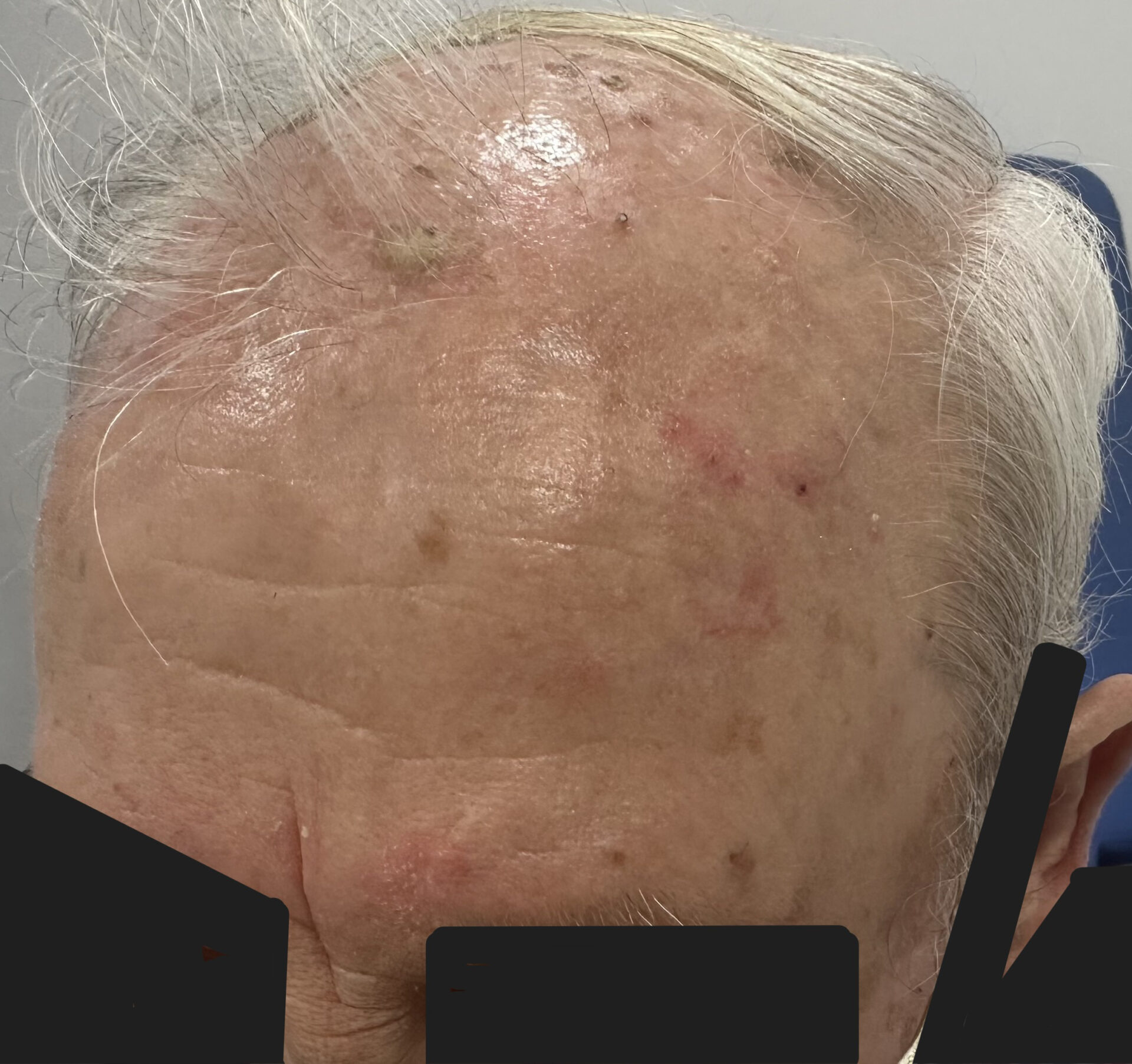 Multiple actinic keratoses on scalp. Photo_ Almirall, SA