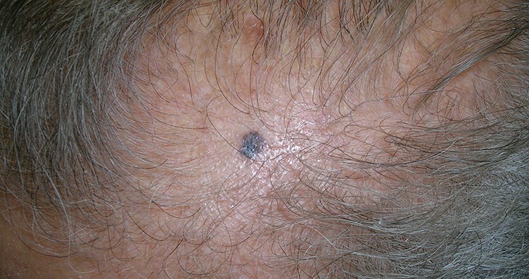 Pigmented basal cell carcinoma on scalp
