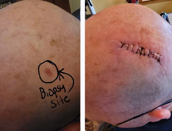 SCC Before and after Mohs surgery