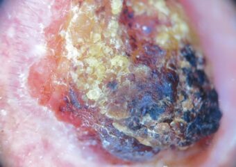 Squamous cell carcinoma .Photo: International Skin Imaging Collaboration at isic-archive.com