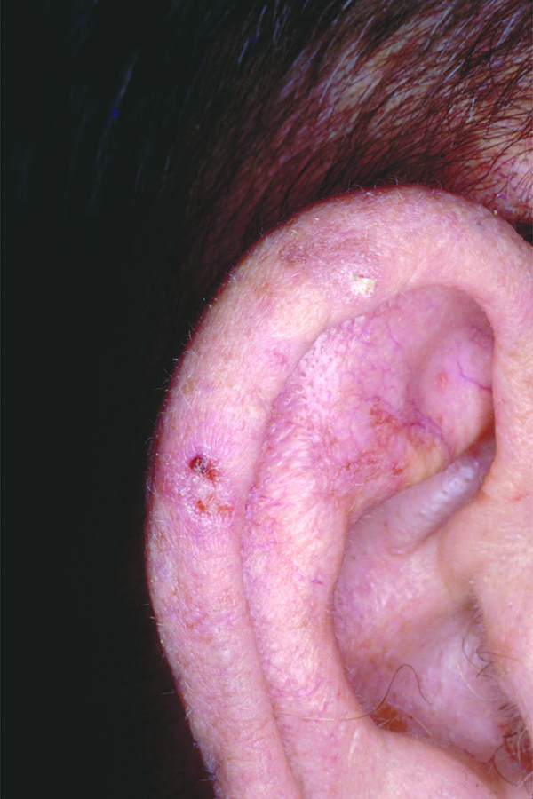 SCF-Actinic keratosis on the ear