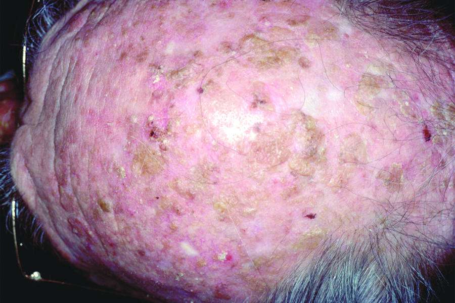 SCF-AK-Scalp-01-medium