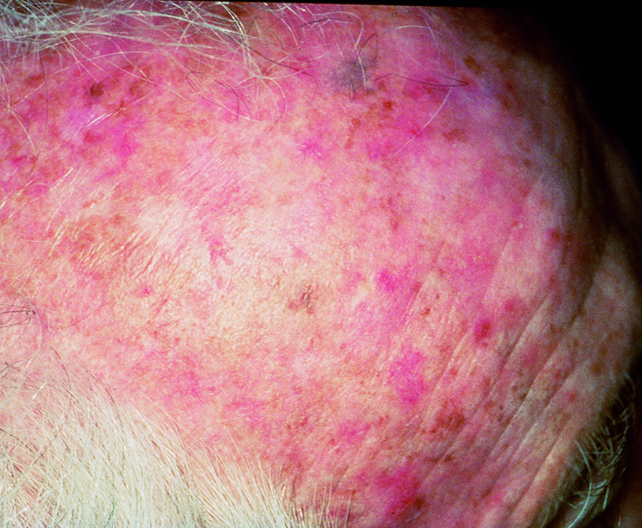 SCF-AK-scalp-030B-medium