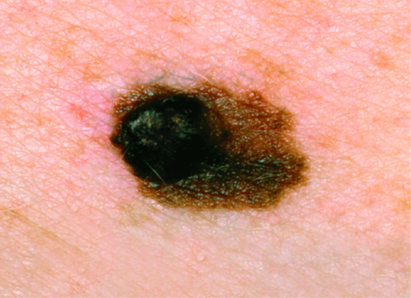 SCF – Dark melanoma with irregular borders