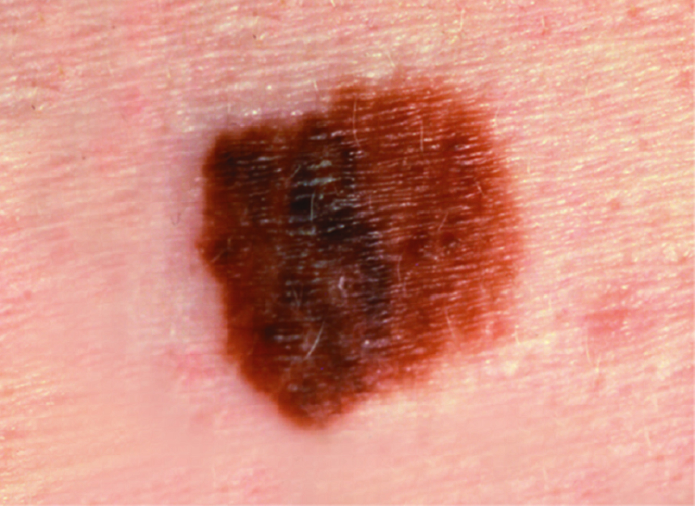 SCF Melanoma with irregular borders and differing colors