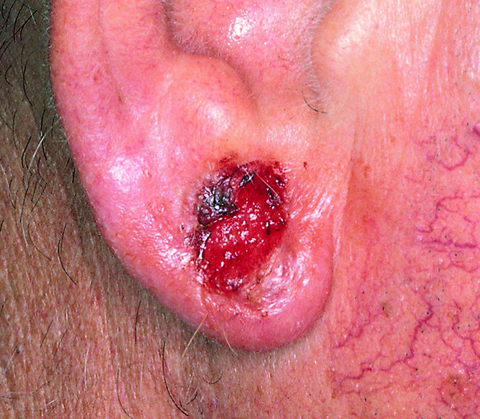 SCF_Basal cell carcinoma presenting as an open sore on the ear 700