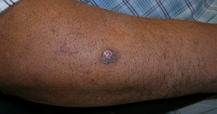 Squamous cell carcinoma on forearm of man with darker skin tone