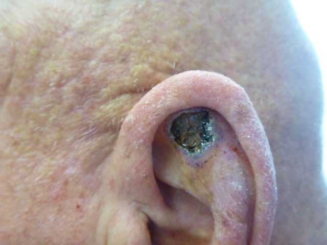 Squamous Cell Carcinoma – open sore that bleeds