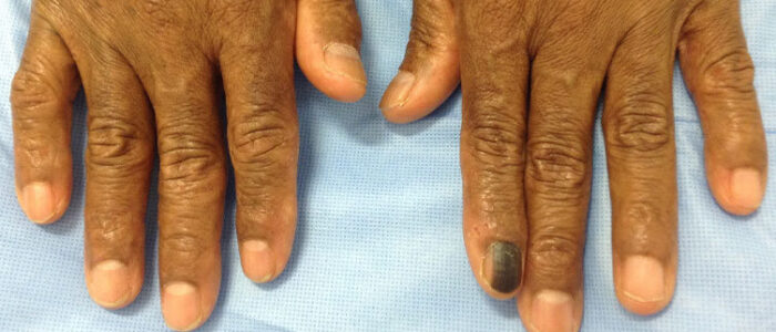 Subungual melanoma on fingernail