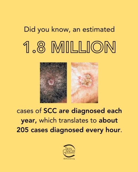Image showing that 1.8 million cases of SCC are diagnosed each year, which translates to about 205 cases diagnosed every hour. Includes two pictures of SCC on different skin tones.