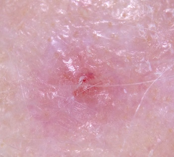 amelanotic-melanoma-scalp-crop