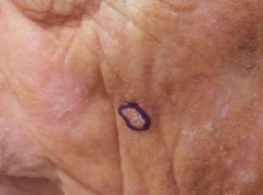 Large squamous cell carcinoma